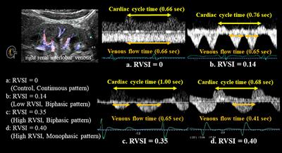 Renal Venous Stasis Index Reflects Renal Congestion and Predicts Adverse Outcomes in Patients With Heart Failure